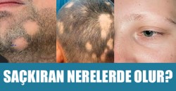 Alopecia Areata Görülen Yerler